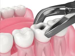 tooth extraction
