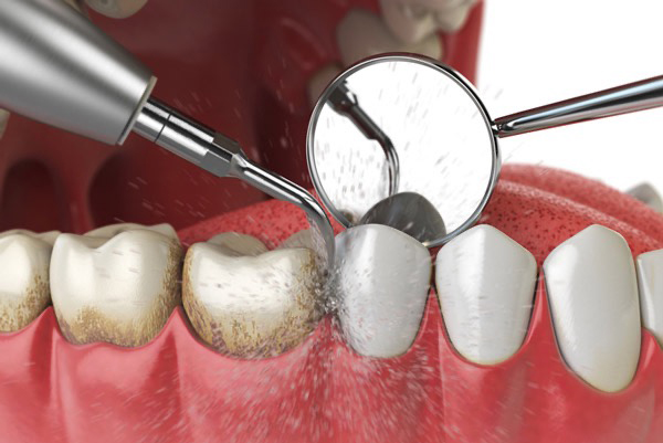 Periodontal maintenance